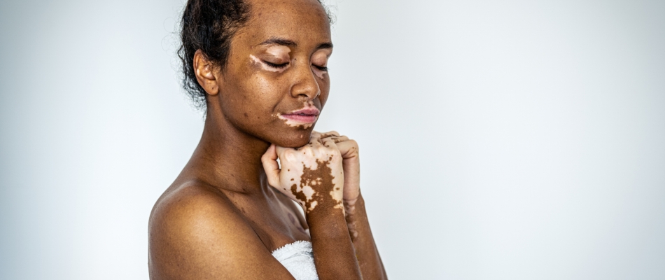 Vitiligo, un premier traitement disponible - Minizap Chambery